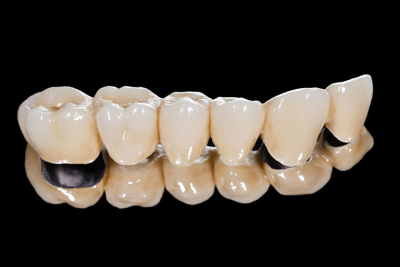 Răng sứ kim loại có tuổi thọ khoảng từ 5-7 năm