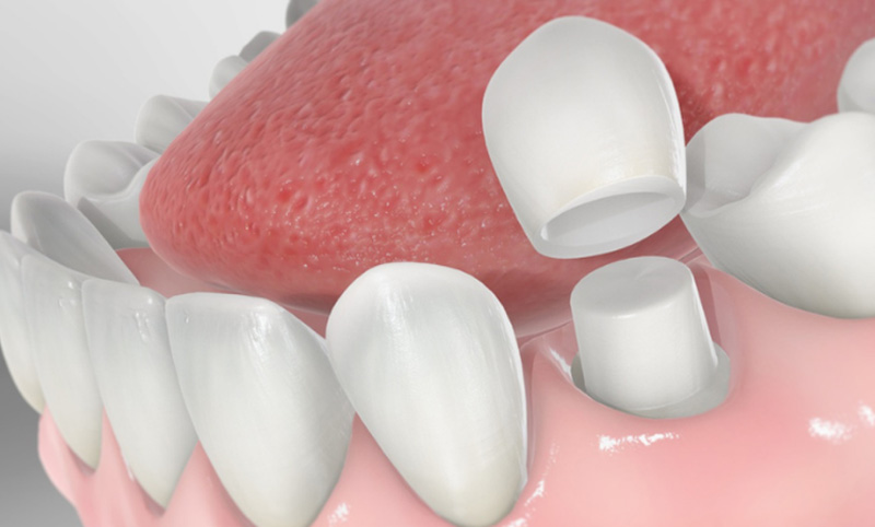 Bọc răng sứ có thể khắc phục tình trạng răng xỉn màu, ố vàng, răng thưa, không đều