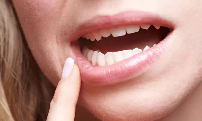 Tuổi thọ răng sứ có thể duy trì được từ 10 - 15 năm
