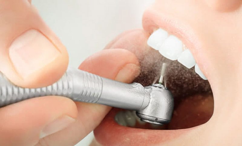 Thời gian bọc răng sứ phụ thuộc vào tay nghề của bác sĩ