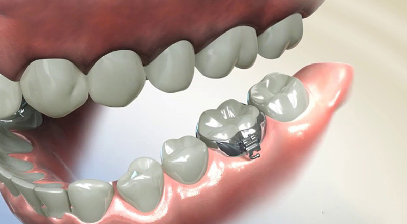 Khâu niềng răng là một khí cụ đóng vai trò quan trọng trong quá trình niềng răng