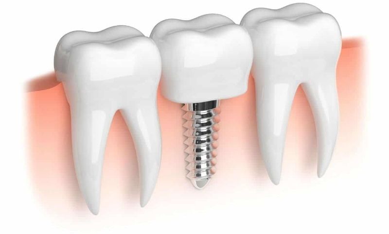 Mini Implant sử dụng cho trường hợp bệnh nhân mất răng toàn hàm trong một thời gian dài