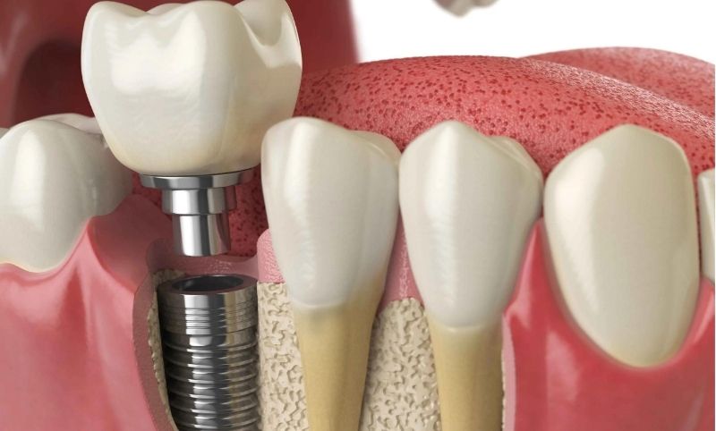 Trụ Mini Implant không có tính ổn định và thời gian sử dụng lâu dài như trụ implant thông thường