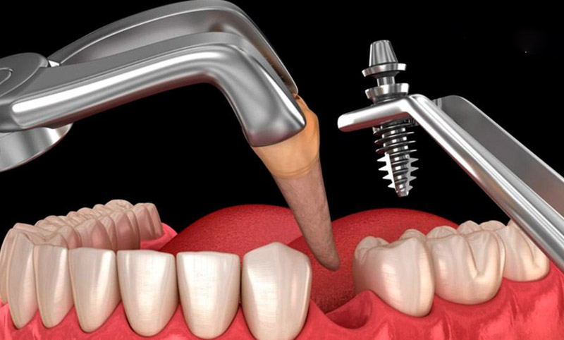 Có thể cấy trụ Implant tức thì ngay sau khi nhổ răng