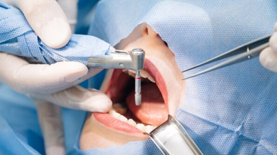 Giải Đáp: Sau Khi Nhổ Răng Bao Lâu Thì Trồng Implant? 