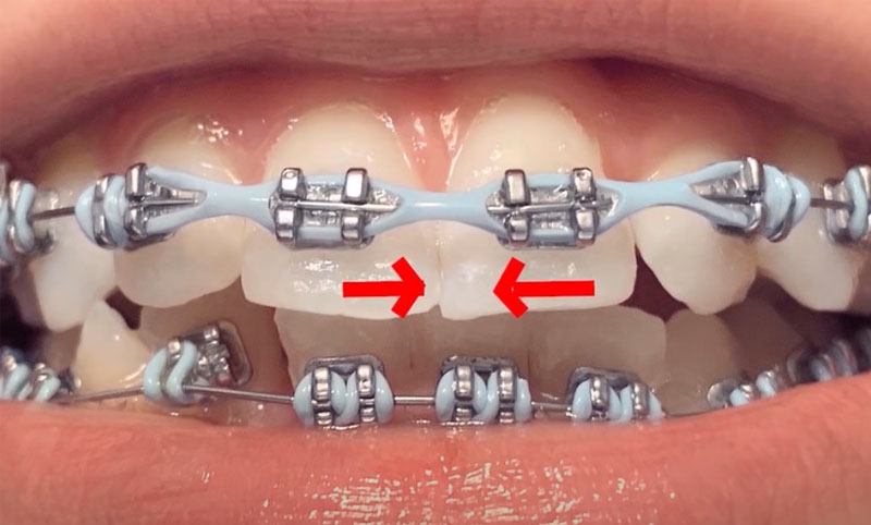 Thun chuỗi chỉnh nha là một dải cao su có nhiều vòng hình tròn được nối với nhau