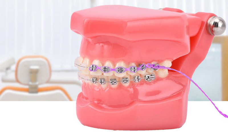 Có rất nhiều loại thun chuỗi niềng răng sử dụng cho từng trường hợp khác nhau