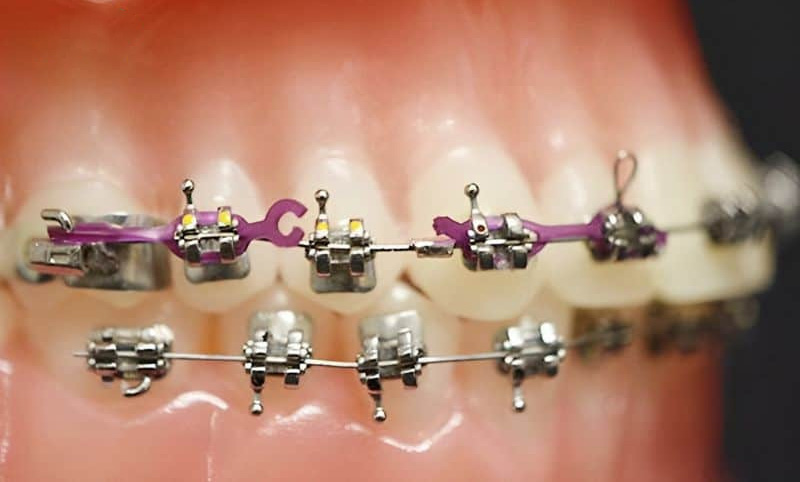 Sử dụng chun kém chất lượng dễ bị đứt, hỏng