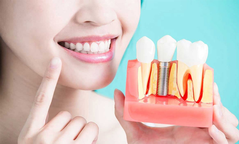 Không ít người thắc mắc trồng răng Implant có vĩnh viễn không