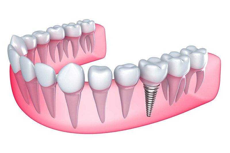 Trụ Implant có rất nhiều kích thước khác nhau