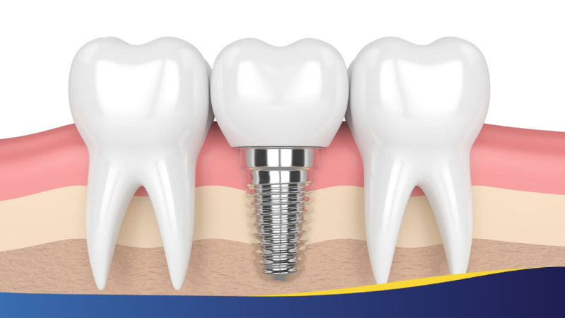 Implant là một loại vít nhỏ, được làm từ titanium