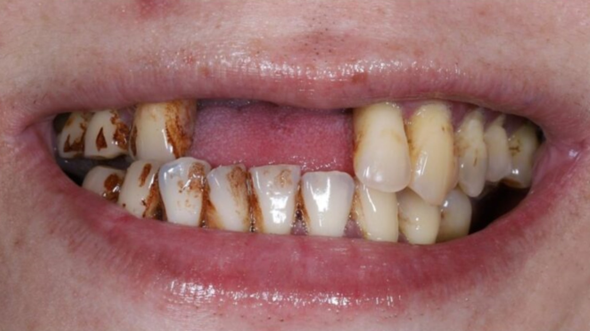 Tình trạng răng của chị Vân trước khi trồng Implant