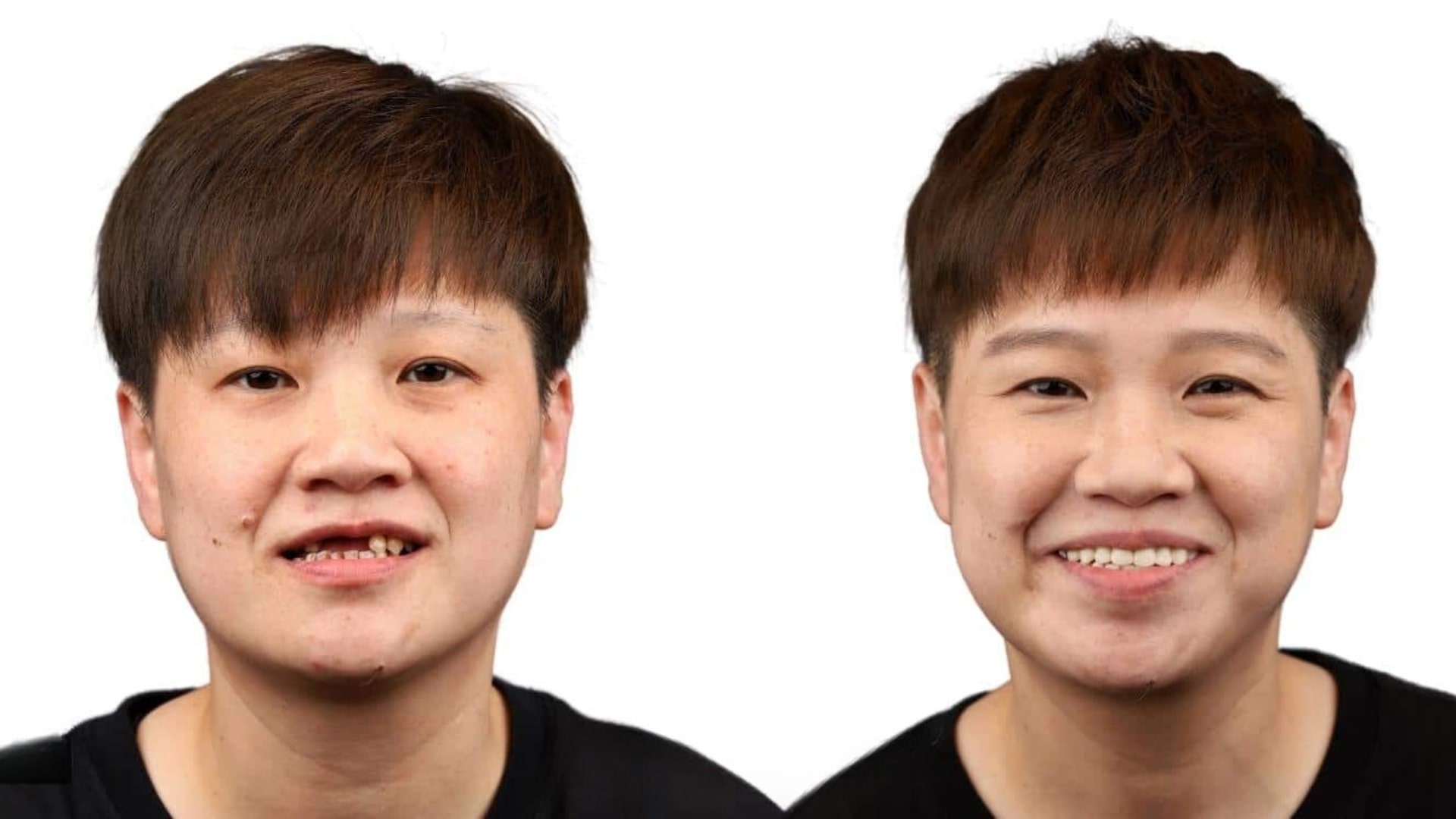 Chị Vân trước và sau khi trồng răng tại ViDental