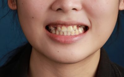 Mất răng khiến Hà mất tự tin vào bản thân và đánh mất nhiều cơ hội