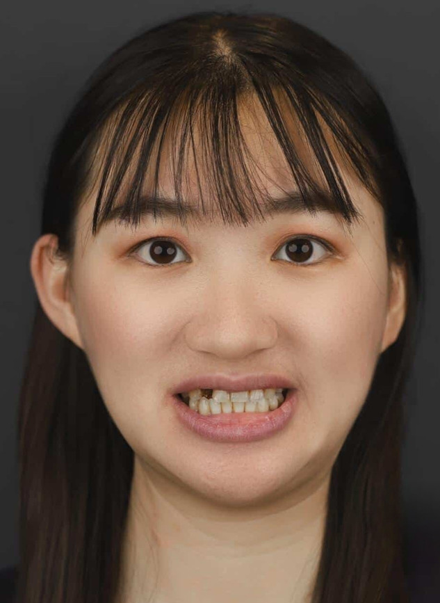 Hình ảnh của Linh trước khi trồng răng Implant