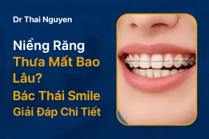 Niềng răng thưa mất bao lâu